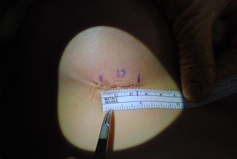 Cicatrice obtenue avec les nouvelles prothèses mammaires en cas d'augmentation par chirurgie à Tournai